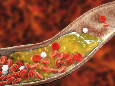 کلسترول خون چیست و راه های کاهش آن